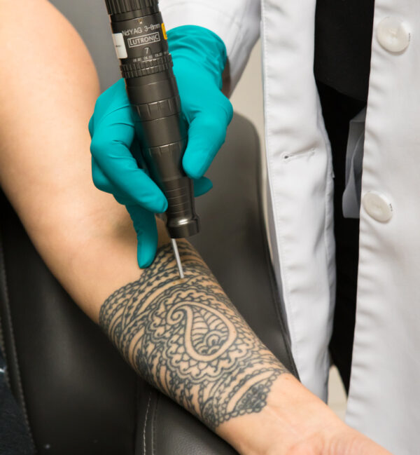 Laser Tattoo Removal Jacksonville, FL Near Me