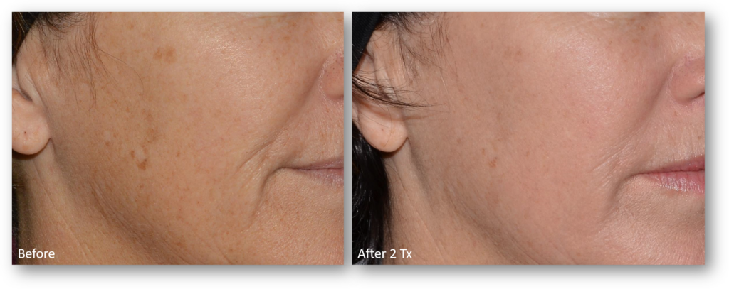 Laser Skin Resurfacing before and after 1