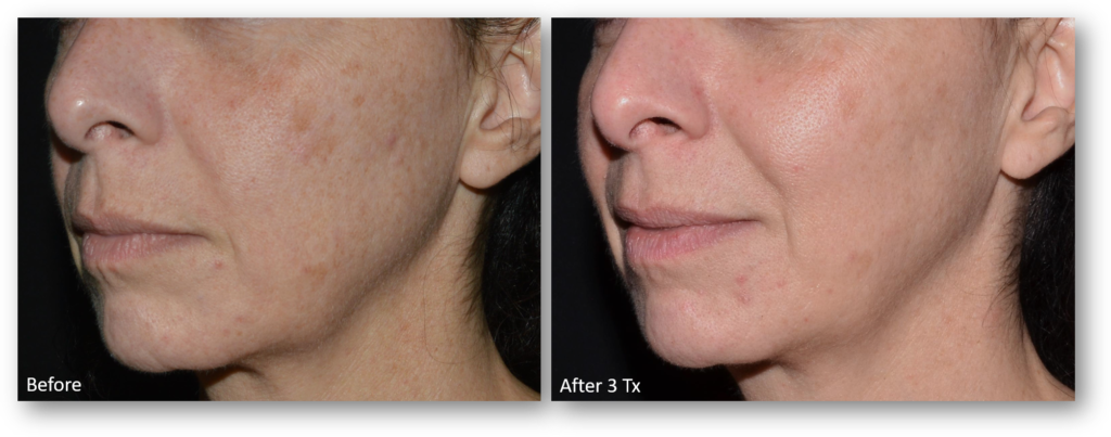 Laser Skin Resurfacing before and after 2