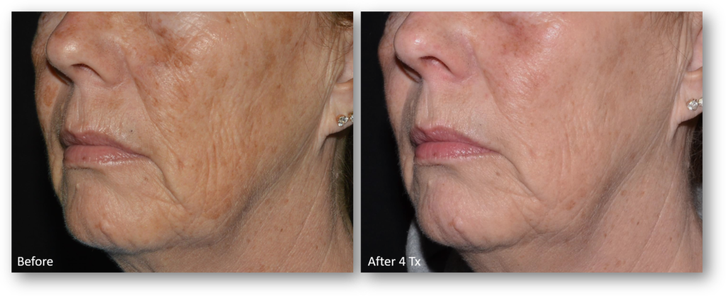 Laser Skin Resurfacing before and after 3