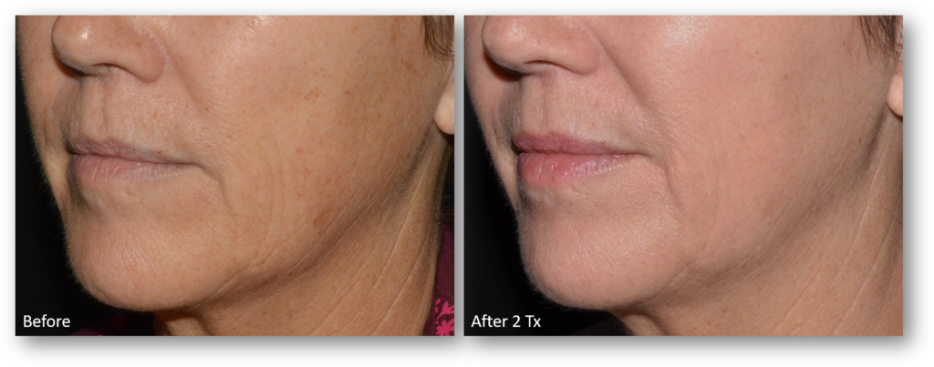 Dysport before and after 1