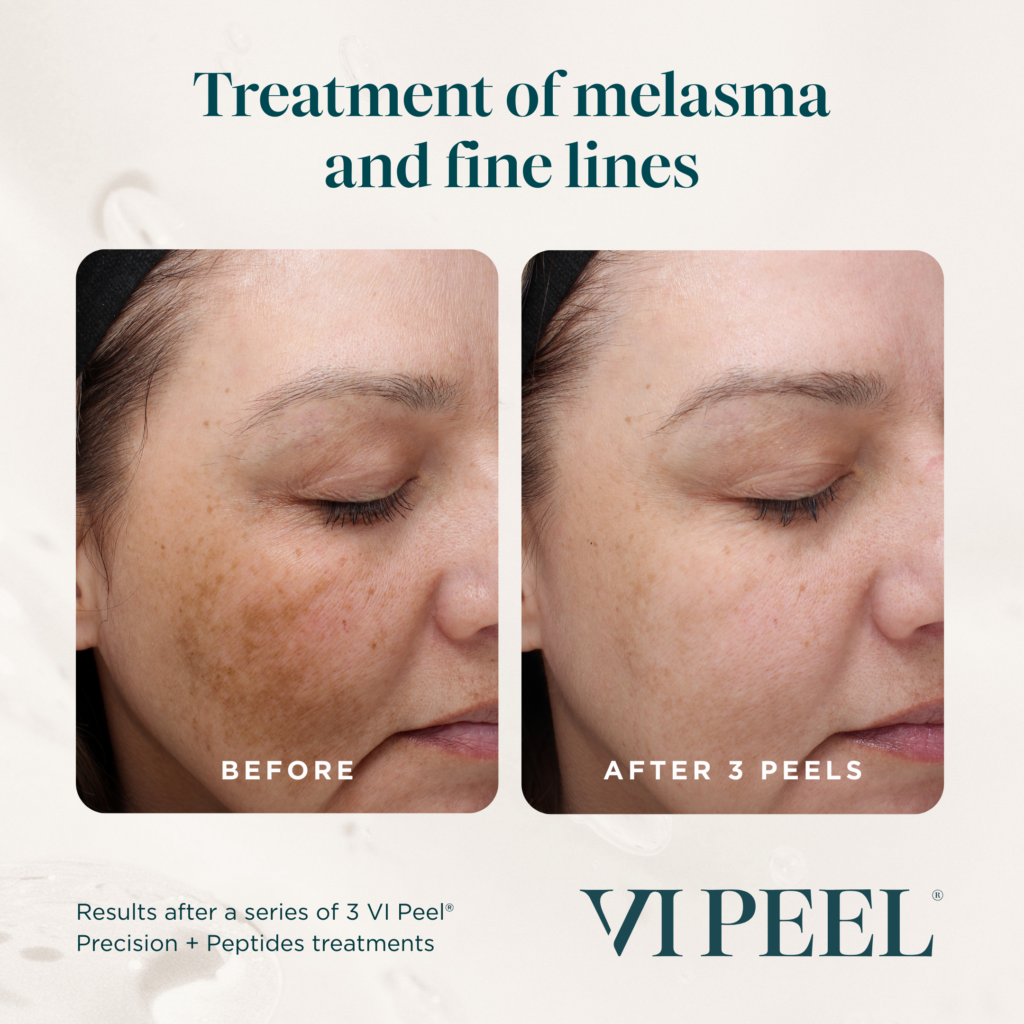 Before and after results treating melasma and fine lines with VI Peel