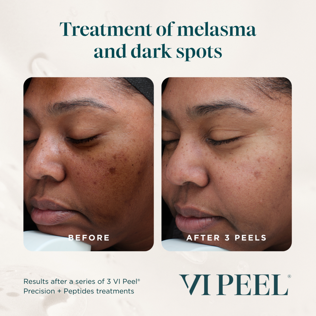 Before and after treatment of melasma and dark spots with VI Peel