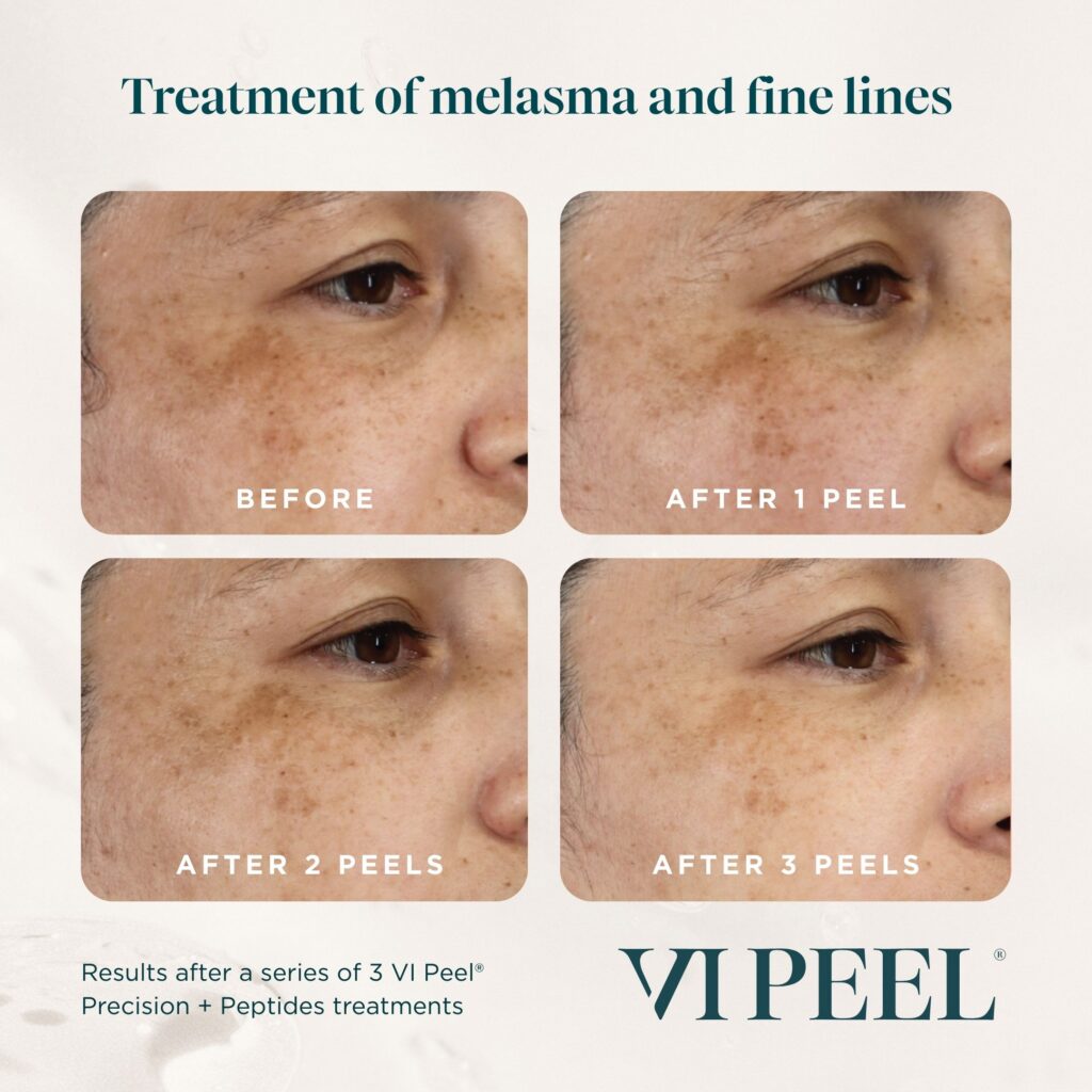 Progression of melasma and fine line improvement after 1 and 3 VI Peel treatments