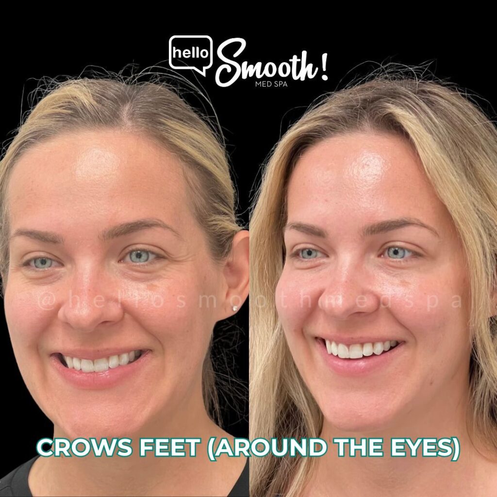 Botox before and after crows feet