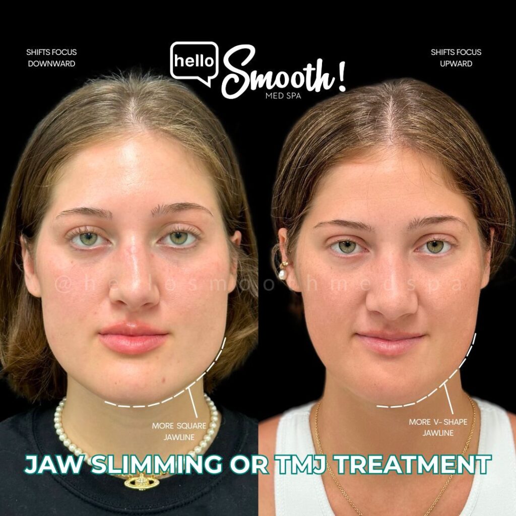 Botox before and after jaw slimming